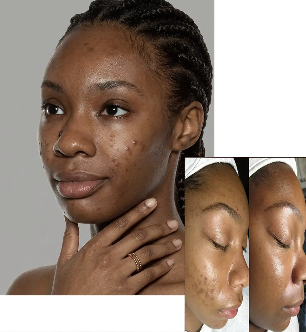 acne and marks removal